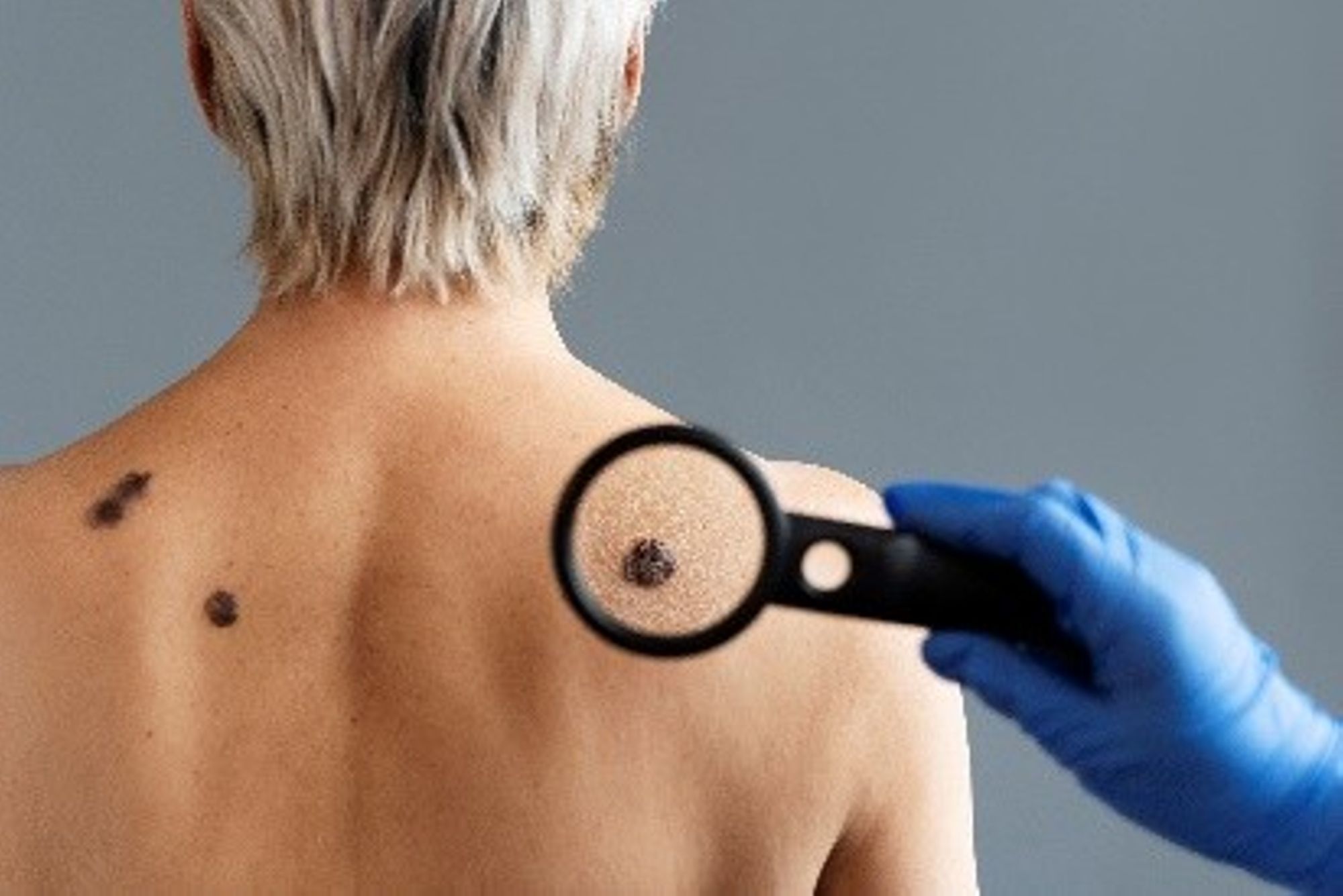 A VOS AGENDAS : Journée de dépistage du cancer de la peau