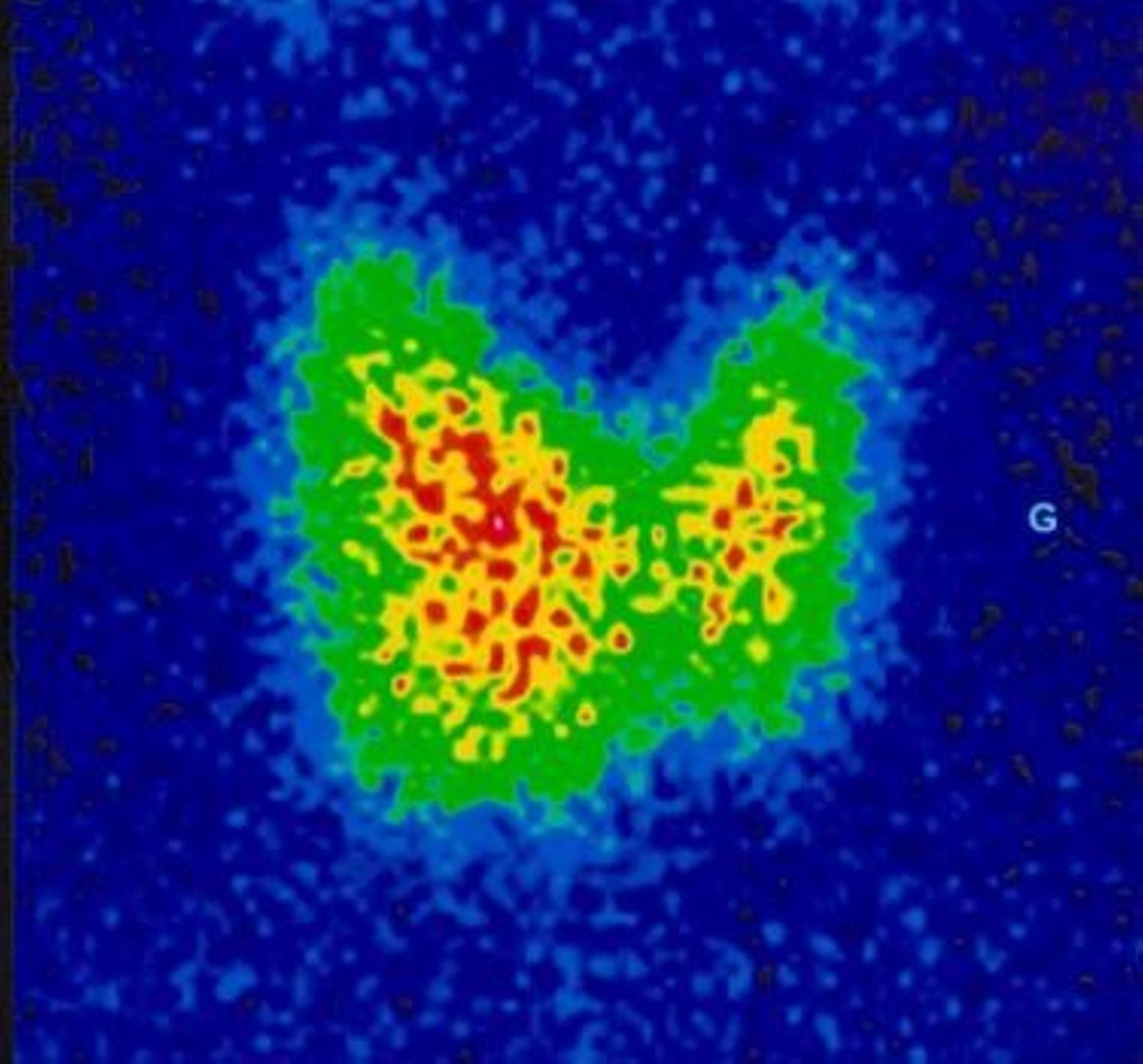 Anomalies thyroïdiennes
