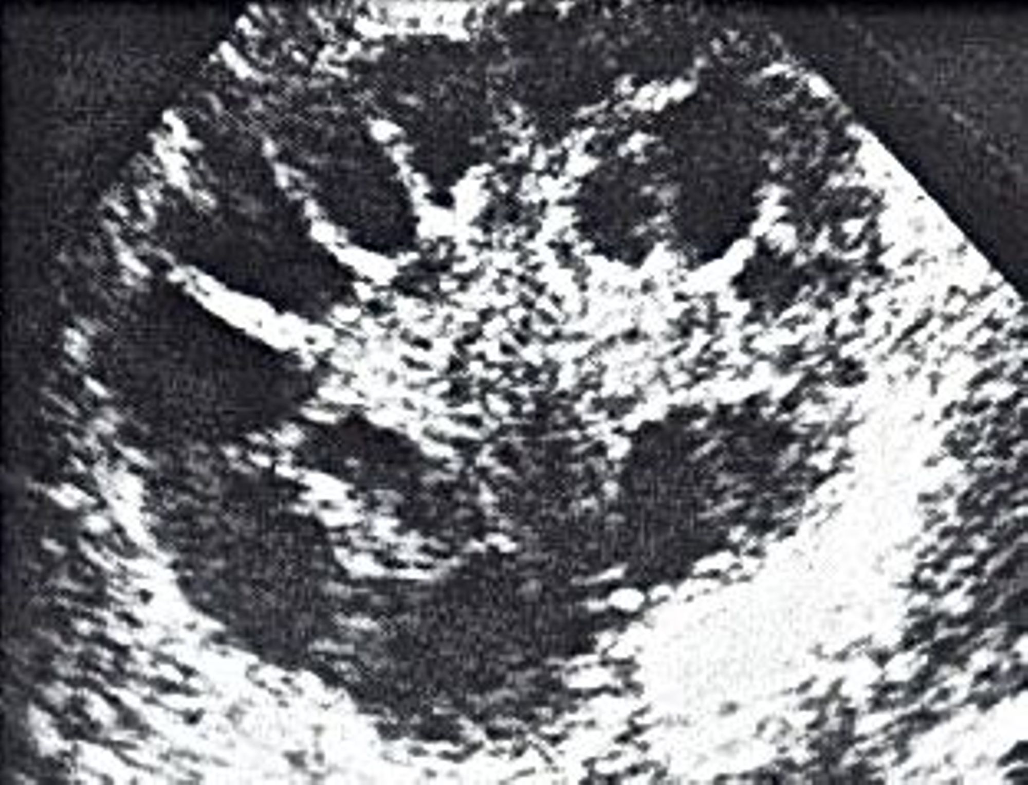 Syndrome des Ovaires Polykystiques : SOPK 