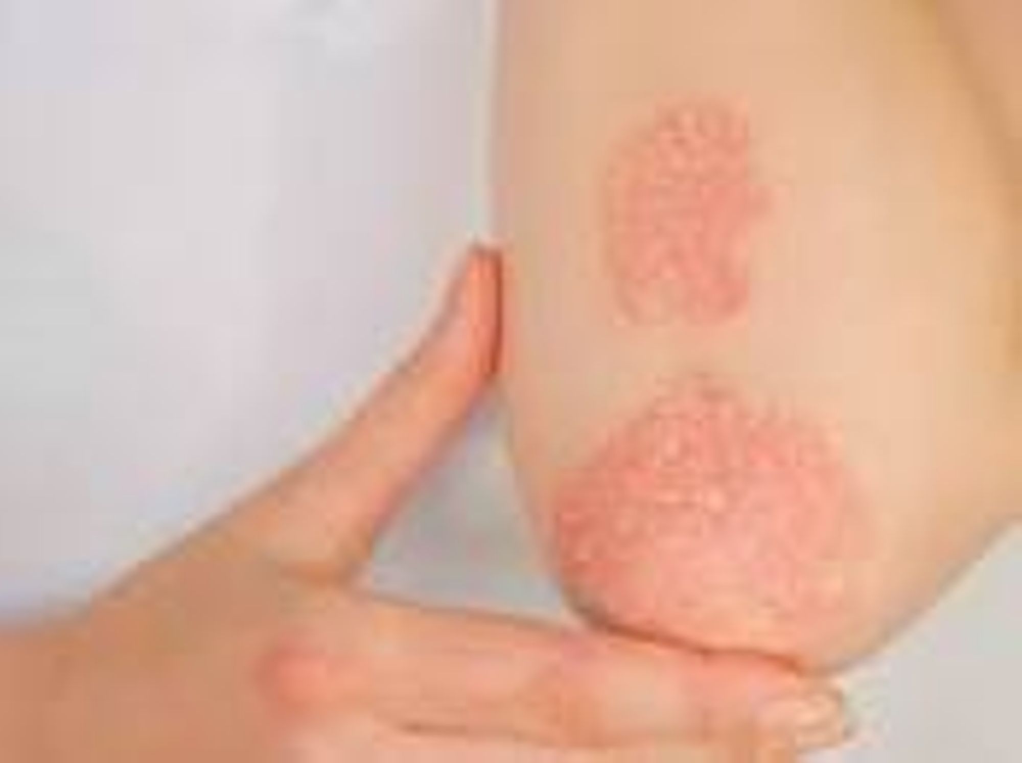 A VOS AGENDAS : Jeudi 20 novembre, Pso dating :  journée d’information sur le psoriasis 