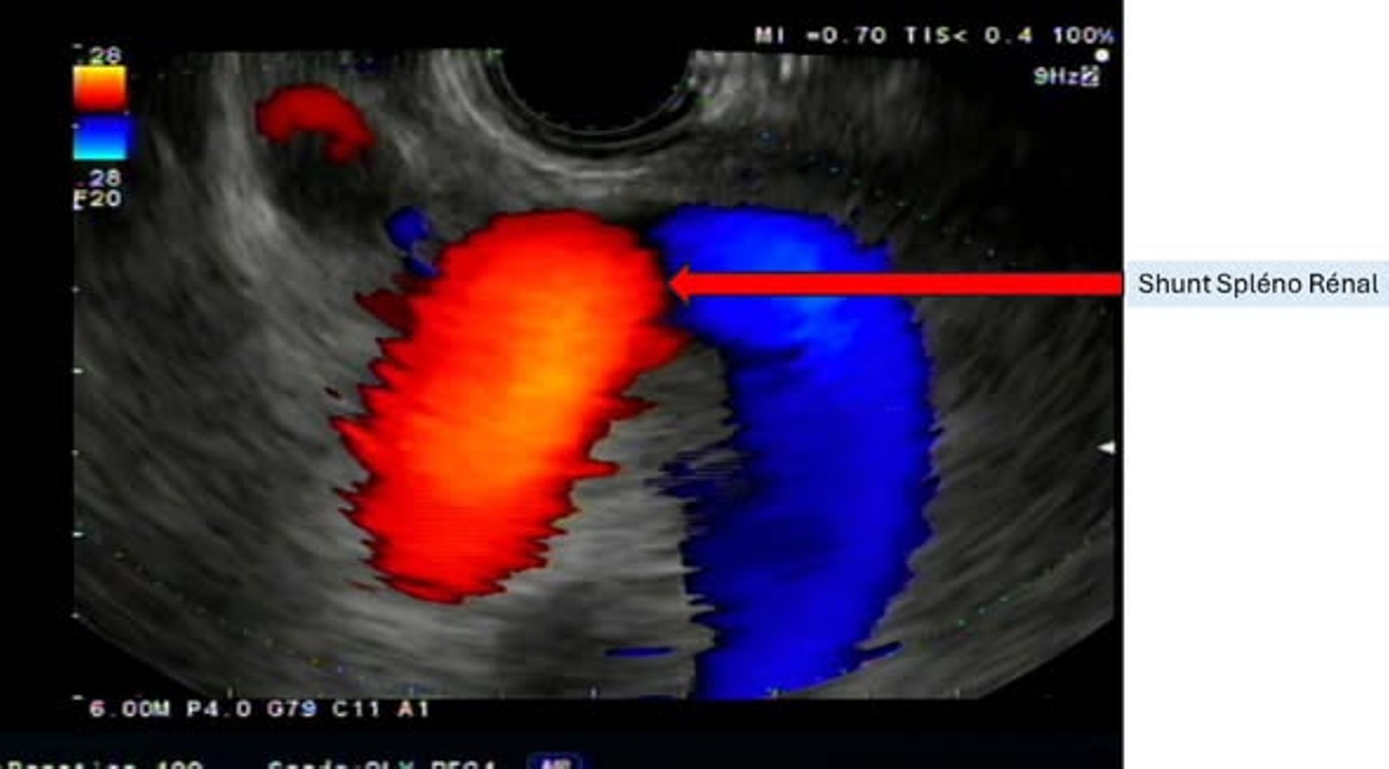 1re Européenne à l'Hôpital Saint Joseph en hépato-gastroentérologie